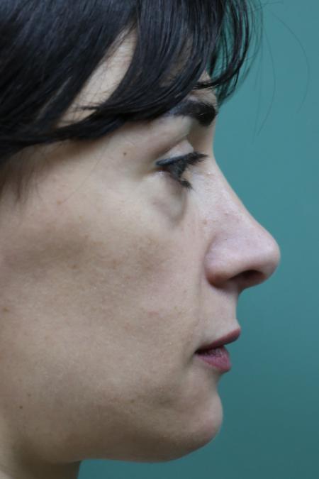 Before image 4 Case #120921 - Midface rejuvination
