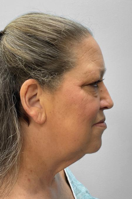 Before image 3 Case #122166 - Facelift and Blepharoplasty