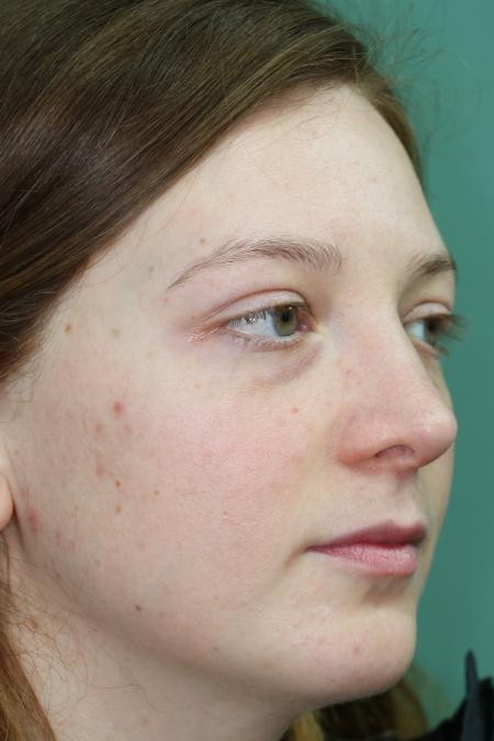 After image 2 Case #122481 - Aesthetic Reduction Rhinoseptoplasty