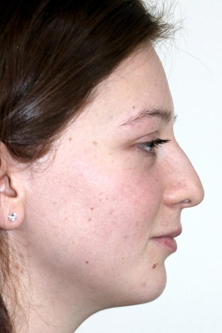 Before image 4 Case #122481 - Aesthetic Reduction Rhinoseptoplasty