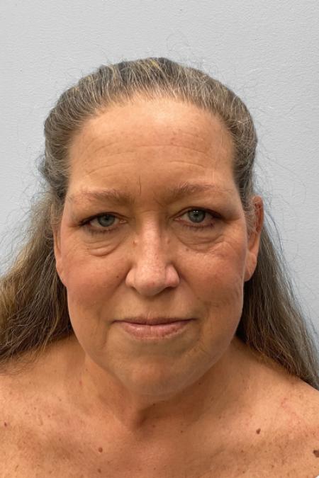 Before image 1 Case #122166 - Facelift and Blepharoplasty