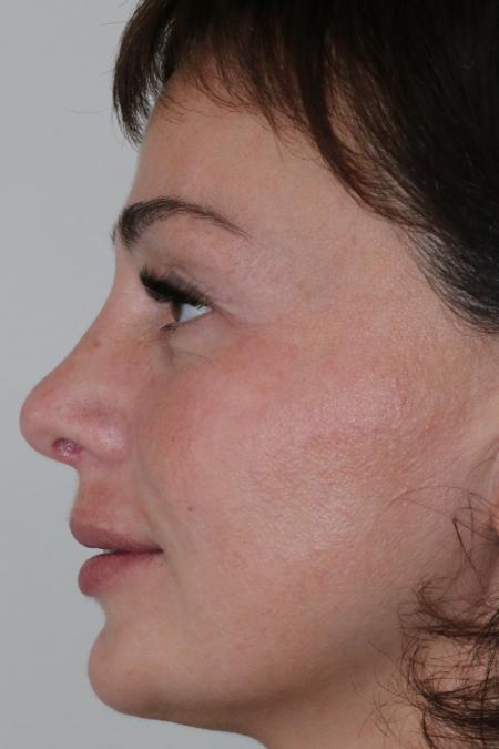 After image 4 Case #122476 - Aesthetic Reduction Rhinoseptoplasty