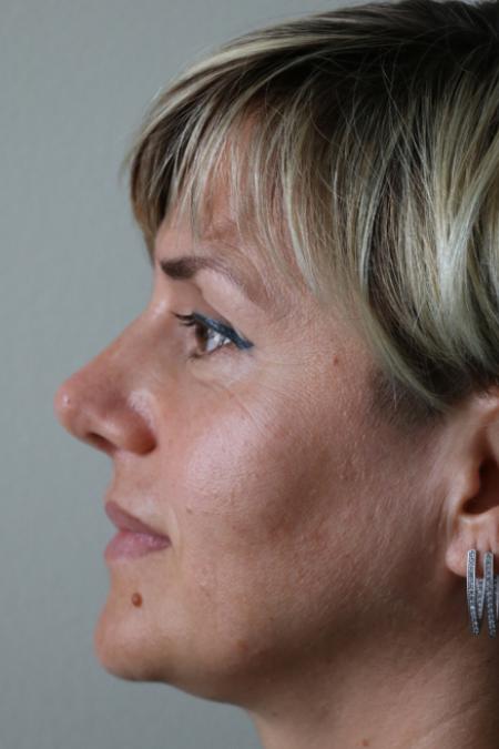 After image 6 Case #122406 - Aesthetic Reduction Rhinoseptoplasty