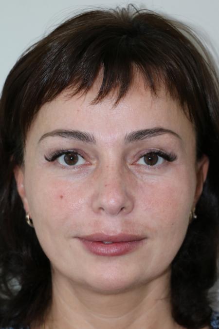 After image 1 Case #122476 - Aesthetic Reduction Rhinoseptoplasty