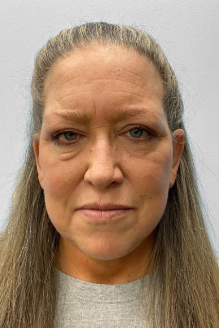 After image 1 Case #122166 - Facelift and Blepharoplasty