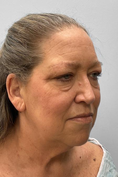 Before image 2 Case #122166 - Facelift and Blepharoplasty