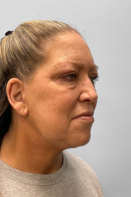 After image 2 Case #122166 - Facelift and Blepharoplasty