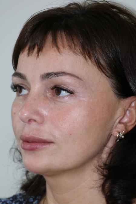 After image 3 Case #122476 - Aesthetic Reduction Rhinoseptoplasty