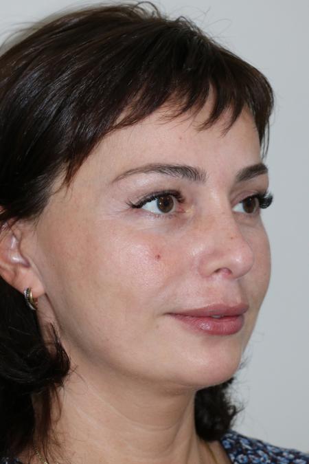 After image 2 Case #122476 - Aesthetic Reduction Rhinoseptoplasty