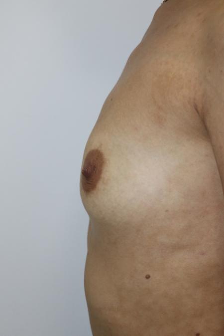 Before image 3 Case #122486 - Breast Augmentation