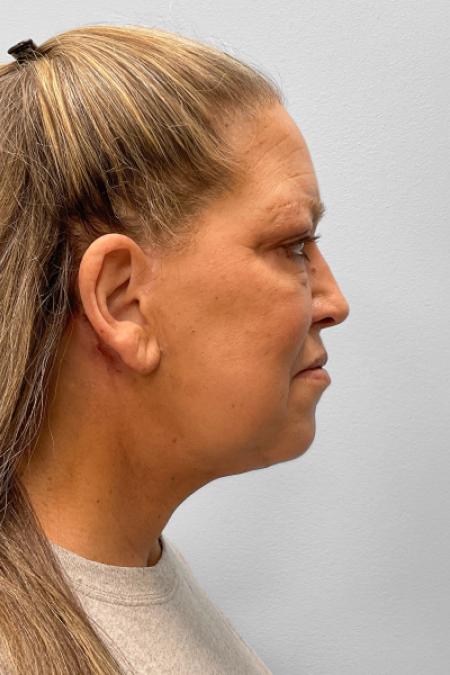 After image 3 Case #122166 - Facelift and Blepharoplasty