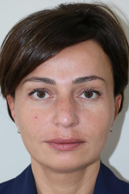 Before image 1 Case #122476 - Aesthetic Reduction Rhinoseptoplasty