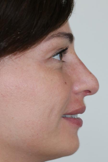 Before image 5 Case #122476 - Aesthetic Reduction Rhinoseptoplasty