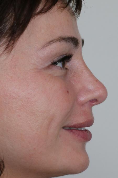 After image 5 Case #122476 - Aesthetic Reduction Rhinoseptoplasty