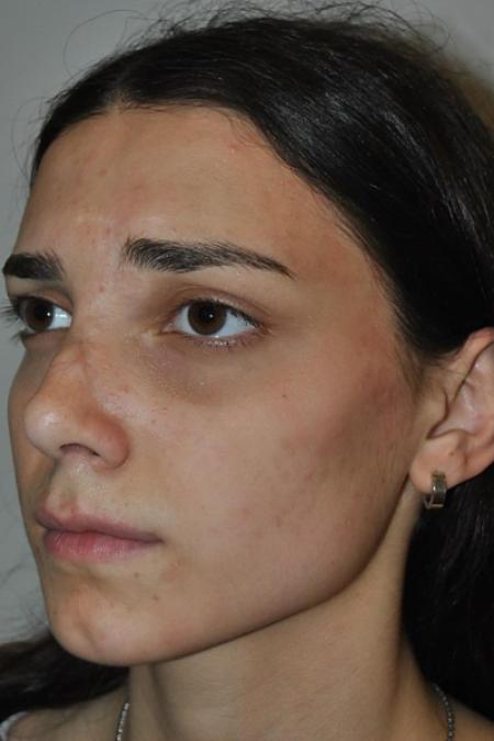 After image 2 Case #122646 - Aestetic Reduction Rhinoplasty