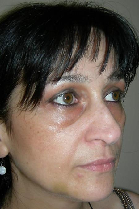 Before image 3 Case #122596 - Aging Rhinoseptoplasty