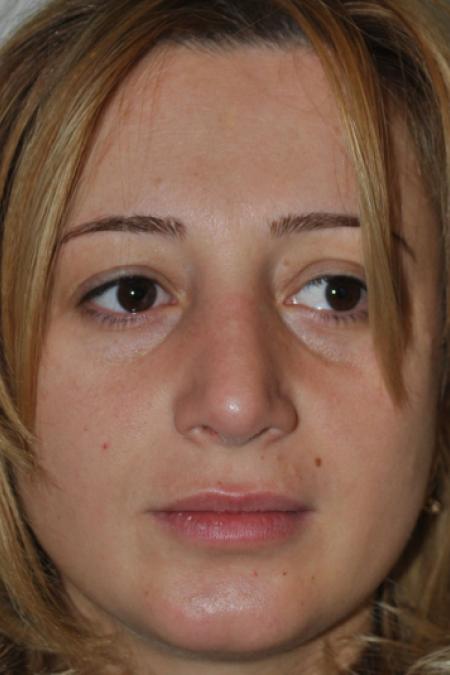 After image 1 Case #122796 - Aesthetic Reduction Conventional Rhinoseptoplasty