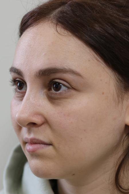 After image 2 Case #122861 - Aesthetic Reduction Rhinoplasty