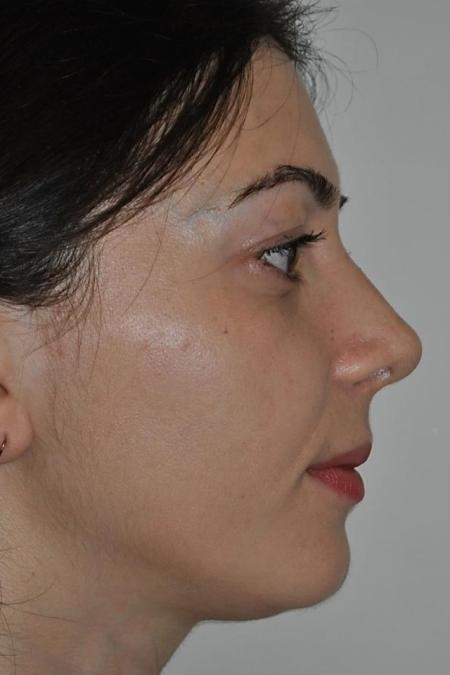 After image 4 Case #122636 - Aestetic Reduction Rhinoseptoplasty