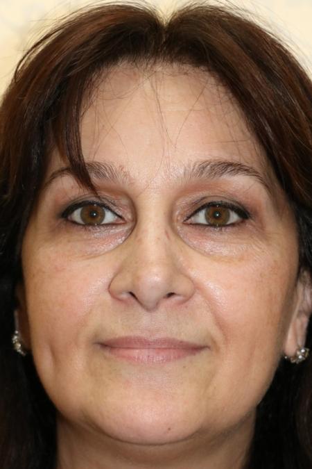 After image 1 Case #122596 - Aging Rhinoseptoplasty
