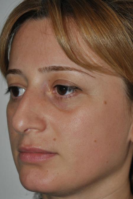 Before image 2 Case #122796 - Aesthetic Reduction Conventional Rhinoseptoplasty