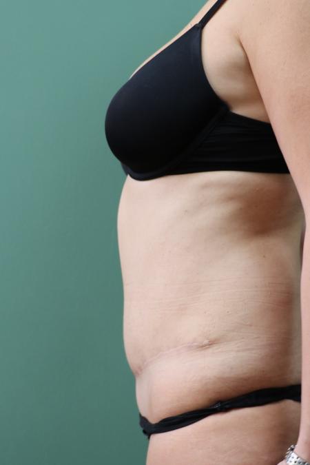 After image 2 Case #122761 - Traditional Abdominoplasty