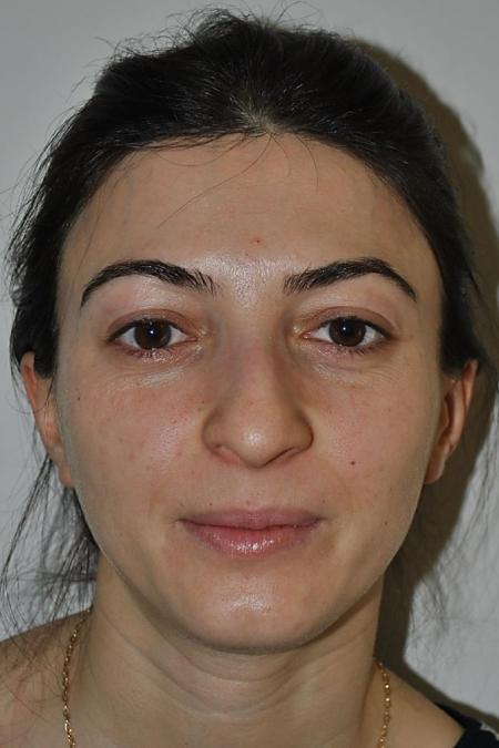 Before image 1 Case #122636 - Aestetic Reduction Rhinoseptoplasty