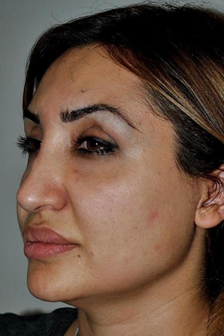 Before image 3 Case #122601 - Aging Rhinoplasty