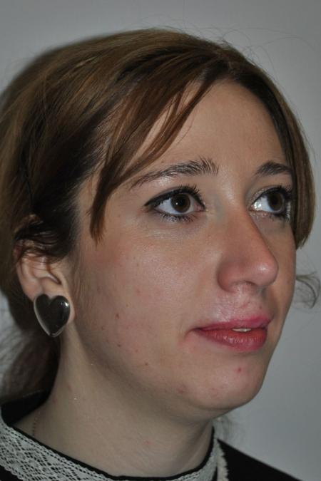 After image 2 Case #122736 - Hybrid Rhinoplasty