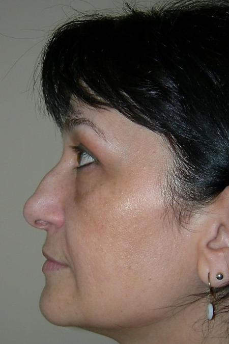 Before image 4 Case #122596 - Aging Rhinoseptoplasty