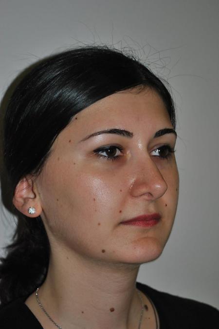 After image 2 Case #122746 - Rhinoseptoplasty