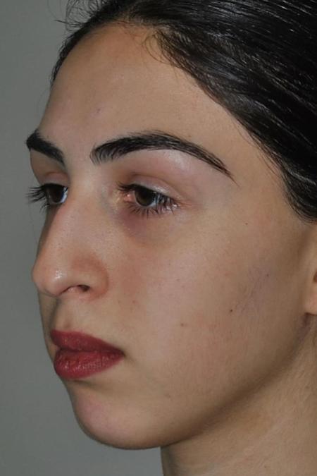 Before image 3 Case #122621 - Aesthetic Reduction Rhinoseptoplasty