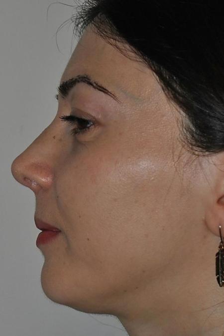 After image 5 Case #122636 - Aestetic Reduction Rhinoseptoplasty