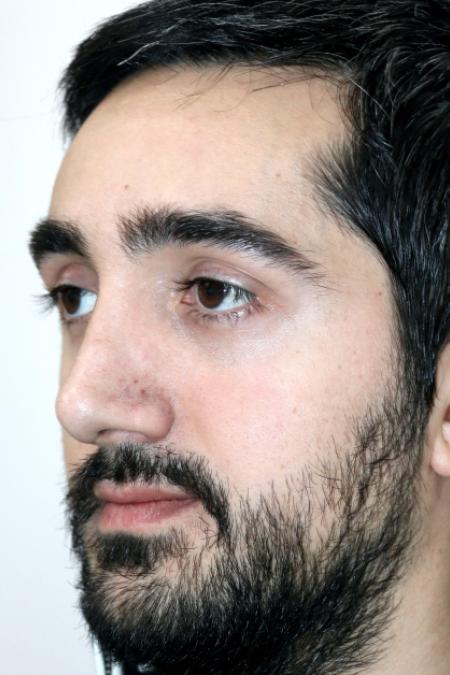 After image 3 Case #122726 - Revision Rhinoseptoplasty, Turbinoplasty