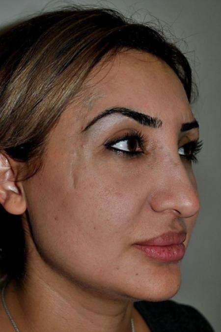 Before image 2 Case #122601 - Aging Rhinoplasty