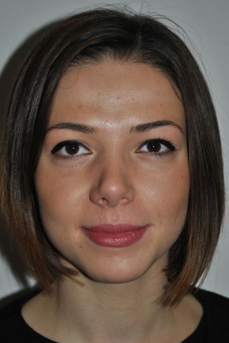 After image 1 Case #122616 - Aesthetic Reduction Rhinoplasty