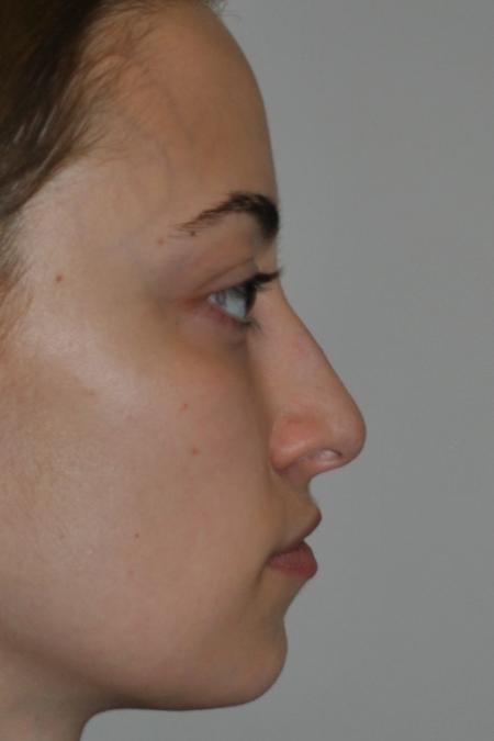 Before image 4 Case #122641 - Aesthetic Reduction Rhinoseptoplasty