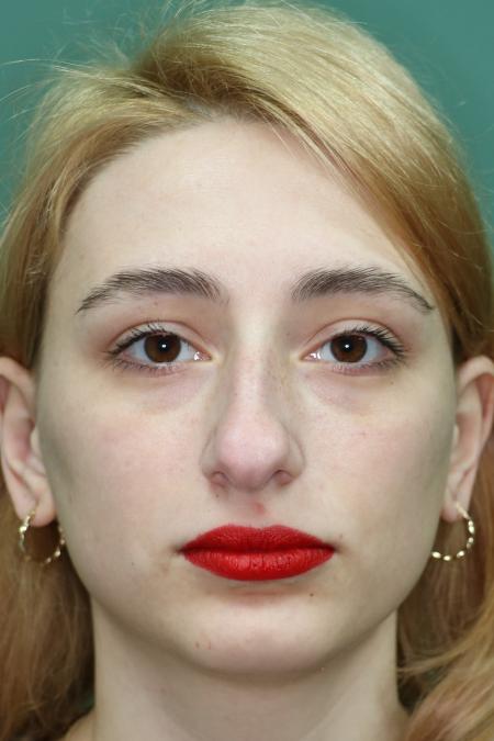 Before image 1 Case #122881 - Deviation Syndrome. Rhinogenic Headache 