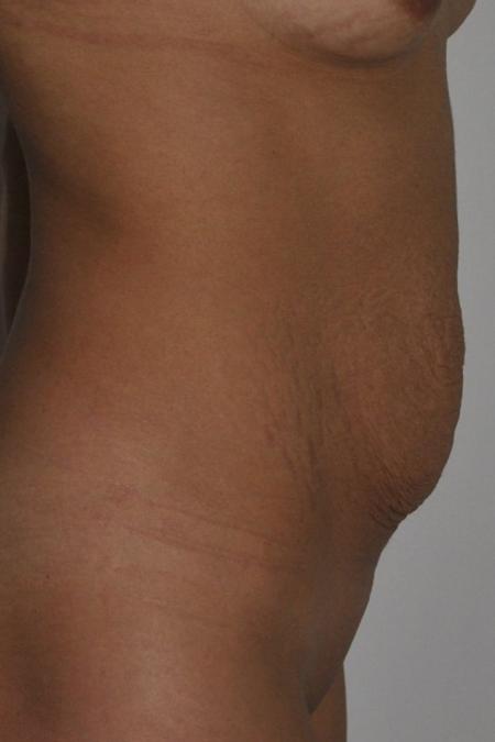 Before image 3 Case #122716 - Abdominoplasty