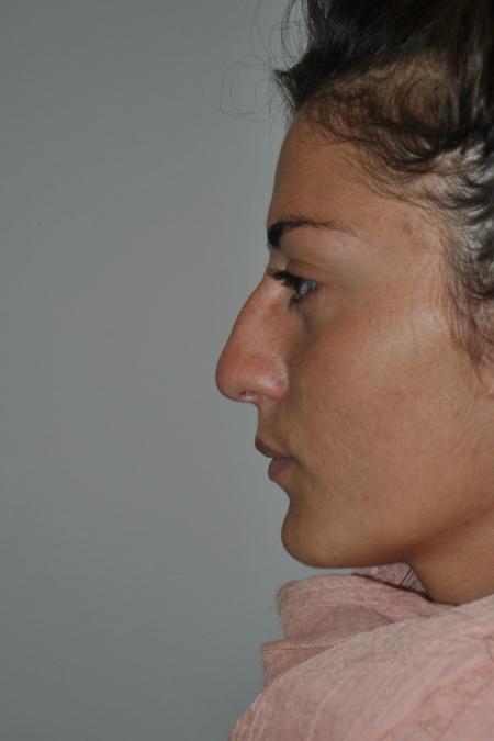 Before image 5 Case #122741 - Primary Rhinoseptoplasty, Turbinate Lateralization