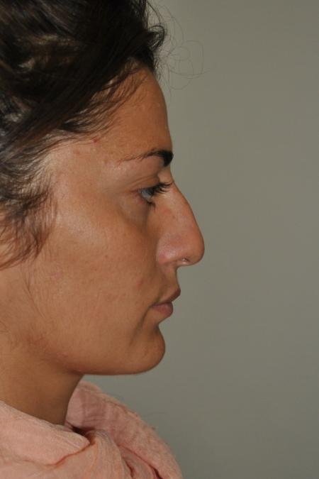 Before image 4 Case #122741 - Primary Rhinoseptoplasty, Turbinate Lateralization