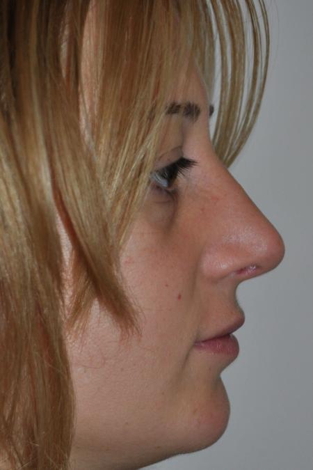 After image 4 Case #122796 - Aesthetic Reduction Conventional Rhinoseptoplasty