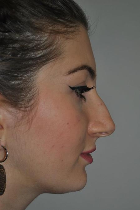Before image 4 Case #122771 - Aesthetic Reduction Rhinoplasty