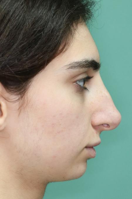 Before image 5 Case #122491 - Aesthetic Reduction Rhinoseptoplasty