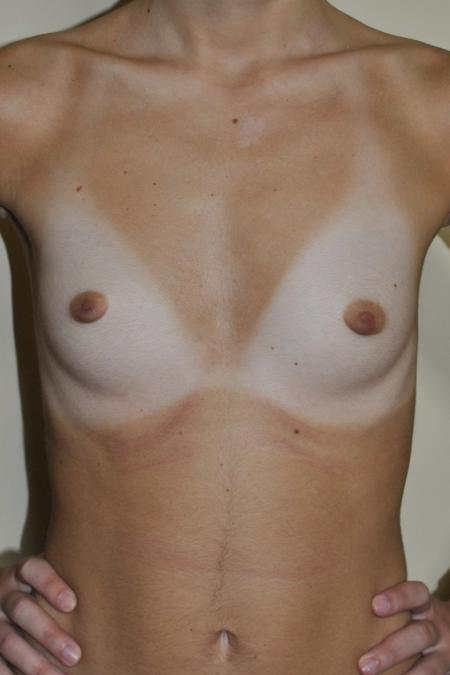 Before image 1 Case #122766 - Breast Augmentation