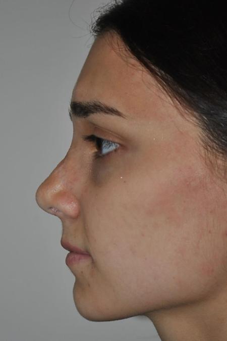 After image 3 Case #122646 - Aestetic Reduction Rhinoplasty