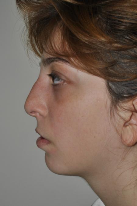 Before image 4 Case #123116 - Late Cleft Lip Nasal Deformity 