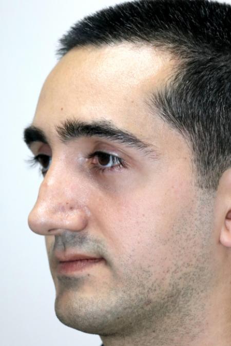 Before image 3 Case #122726 - Revision Rhinoseptoplasty, Turbinoplasty