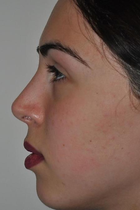 After image 5 Case #122621 - Aesthetic Reduction Rhinoseptoplasty