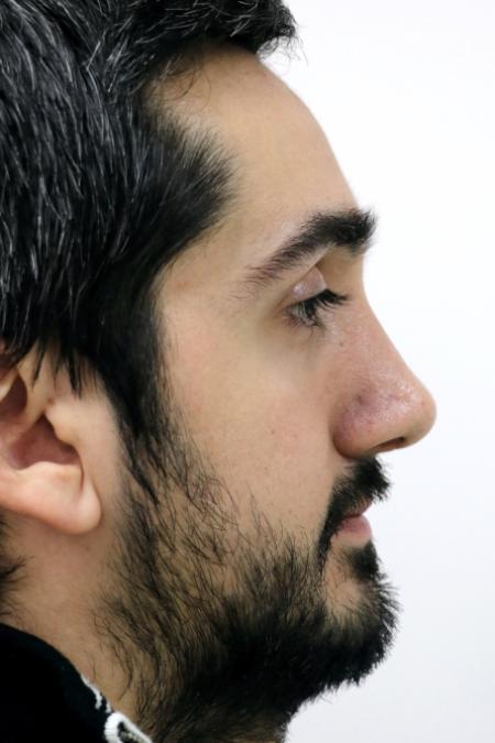 After image 5 Case #122726 - Revision Rhinoseptoplasty, Turbinoplasty